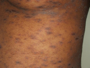 Child with Pityriasis Rosea